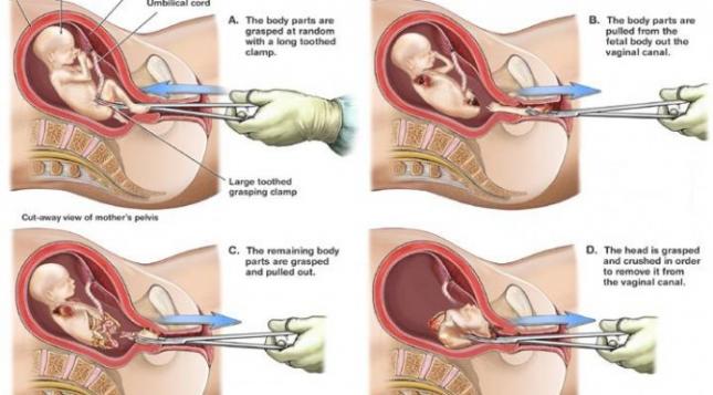 Partial And Late Term Abortion